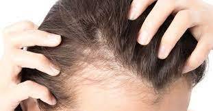 Causes Of Hair Loss And Hair Loss Treatment