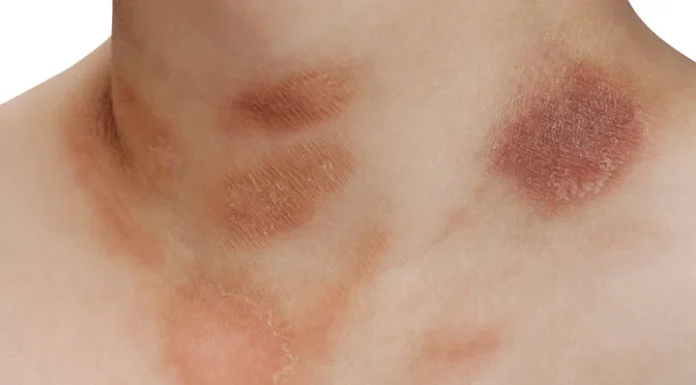 Diagnosing Common Skin Rashes: What To Look For And Treatment Options