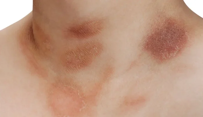 Diagnosing Common Skin Rashes: What To Look For And Treatment Options