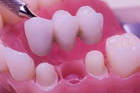 Restoring Your Smile_ The Key to Permanent Tooth Replacement